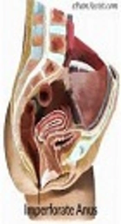 Preoperative Trans-Perineal Sonographic Findings in Children with Imperforate Anus for Detection of Anal Sphincter Muscle Complex and the Anal Canal Pathway: A Pilot Study