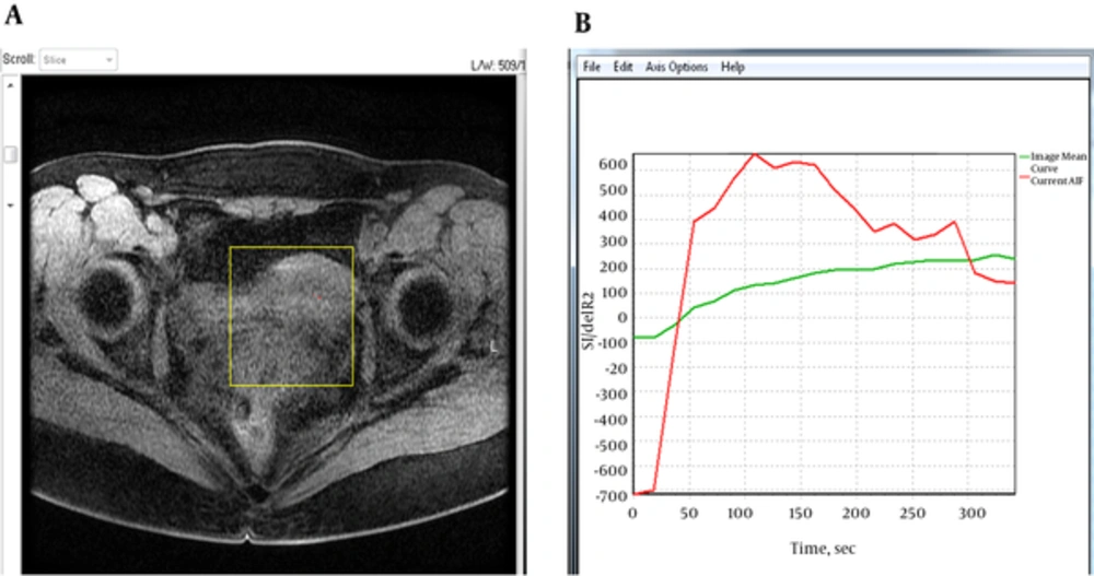 A, Example of an axial T1-weighted image of the pelvis with region of interest (yellow box) drawn over the uterus for quantitative dynamic contrast-enhanced magnetic resonance imaging (DCE-MRI) analysis. B, Mean signal intensity curve (green) and arterial input function (AIF) (red) for the selected tissues. A, Example of an axial T1-weighted image of the pelvis with region of interest (yellow box) drawn over the uterus for quantitative dynamic contrast-enhanced magnetic resonance imaging (DCE-MRI) analysis. B, Mean signal intensity curve (green) and arterial input function (AIF) (red) for the selected tissues.