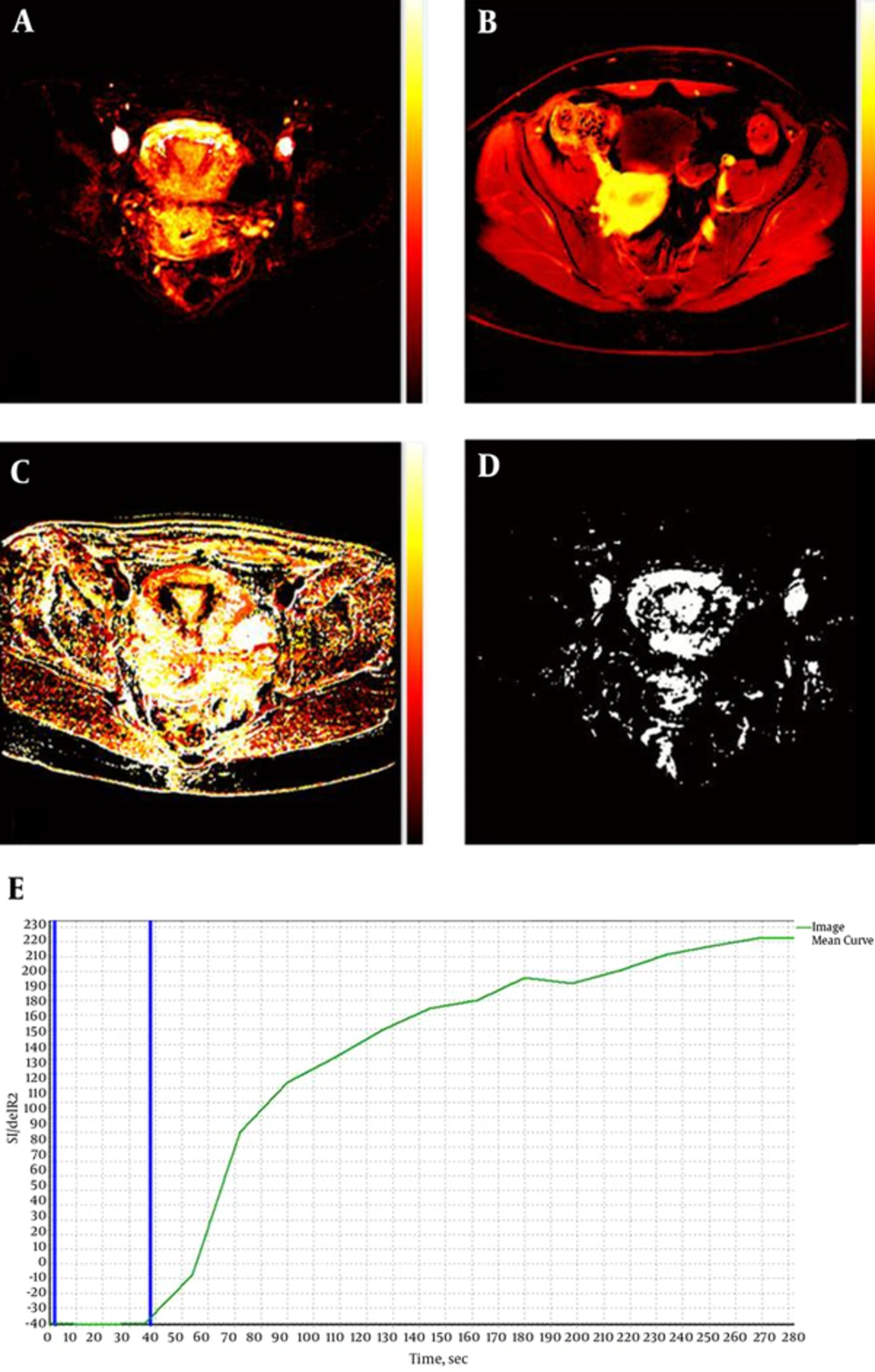 A-D, Semi-quantitative maps of a normal uterus acquired using the dynamic contrast enhanced magnetic resonance imaging (DCE-MRI) software. A, Ktrans; B, initial area under the gadolinium concentration time curve (IAUGC); C, time-to-peak (TTP); D, Ve. ; E, Time-intensity curve of the normal uterus. The two blue lines indicate bolus arrival time (~37 seconds). A-D, Semi-quantitative maps of a normal uterus acquired using the dynamic contrast enhanced magnetic resonance imaging (DCE-MRI) software. A, Ktrans; B, initial area under the gadolinium concentration time curve (IAUGC); C, time-to-peak (TTP); D, Ve. ; E, Time-intensity curve of the normal uterus. The two blue lines indicate bolus arrival time (~37 seconds).