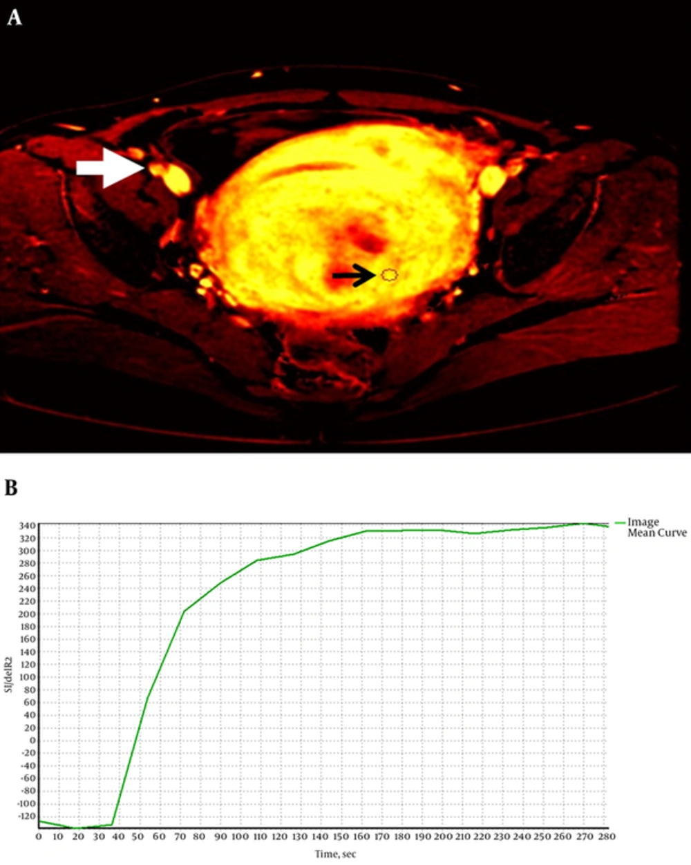A and B, Time-intensity curve of an intramural uterine fibroid. The thick arrow points to the artery where arterial input function (AIF) was obtained and the thin arrow shows the region of interest (ROI) of the fibroid. Ktrans map of a patient with hyperintense (white) fibroid. A and B, Time-intensity curve of an intramural uterine fibroid. The thick arrow points to the artery where arterial input function (AIF) was obtained and the thin arrow shows the region of interest (ROI) of the fibroid. Ktrans map of a patient with hyperintense (white) fibroid.
