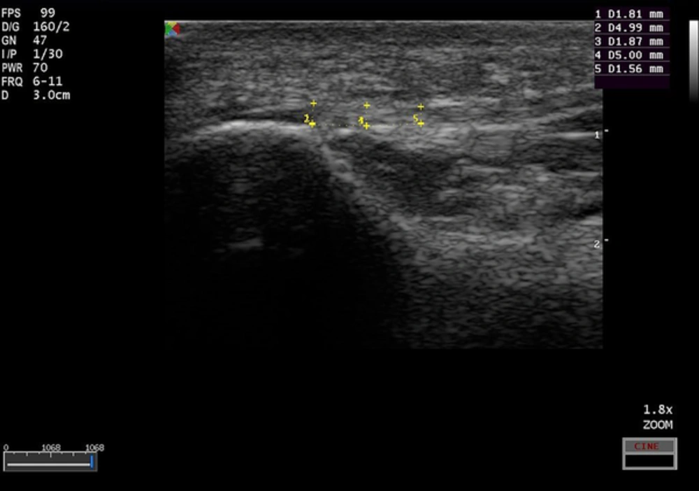 Normal plantar fascia. Longitudinal sonogram shows thickness of plantar fascia in three points Normal plantar fascia. Longitudinal sonogram shows thickness of plantar fascia in three points