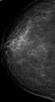 Three Synchronous Bilateral Solid Papillary Carcinomas of the Breast with Different Radiologic Findings: A Case Report