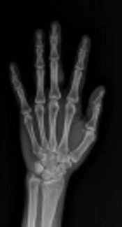 Musculoskeletal Tuberculosis Presenting as Isolated Tuberculous Gumma in an Immunocompetent Patient