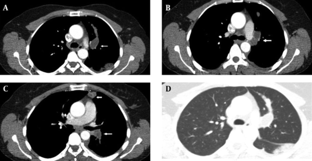 A 48-year-old woman with a one-month history of cough. A-C, CT with contrast shows hypodense masses located in the left main, segmentary branches of the superior lobe and descending pulmonary artery; D, parenchymatous condensation in the superior segment of the lower lobe is seen. A 48-year-old woman with a one-month history of cough. A-C, CT with contrast shows hypodense masses located in the left main, segmentary branches of the superior lobe and descending pulmonary artery; D, parenchymatous condensation in the superior segment of the lower lobe is seen.