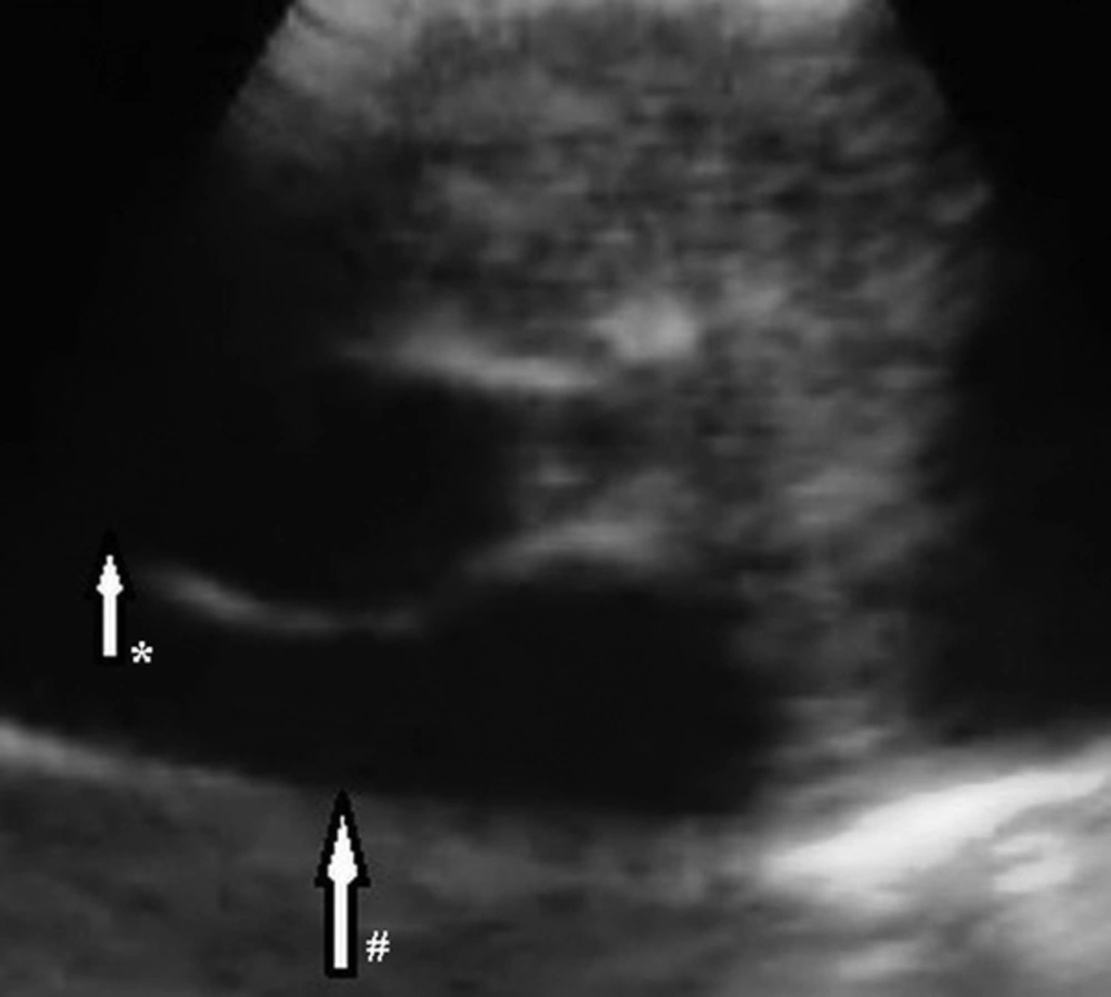 An anechoic cystic lesion is seen inside the left pulmonary artery by EBUS. The cyst in the pulmonary artery is marked with * sign and the pulmonary artery is marked with # sign. An anechoic cystic lesion is seen inside the left pulmonary artery by EBUS. The cyst in the pulmonary artery is marked with * sign and the pulmonary artery is marked with # sign.