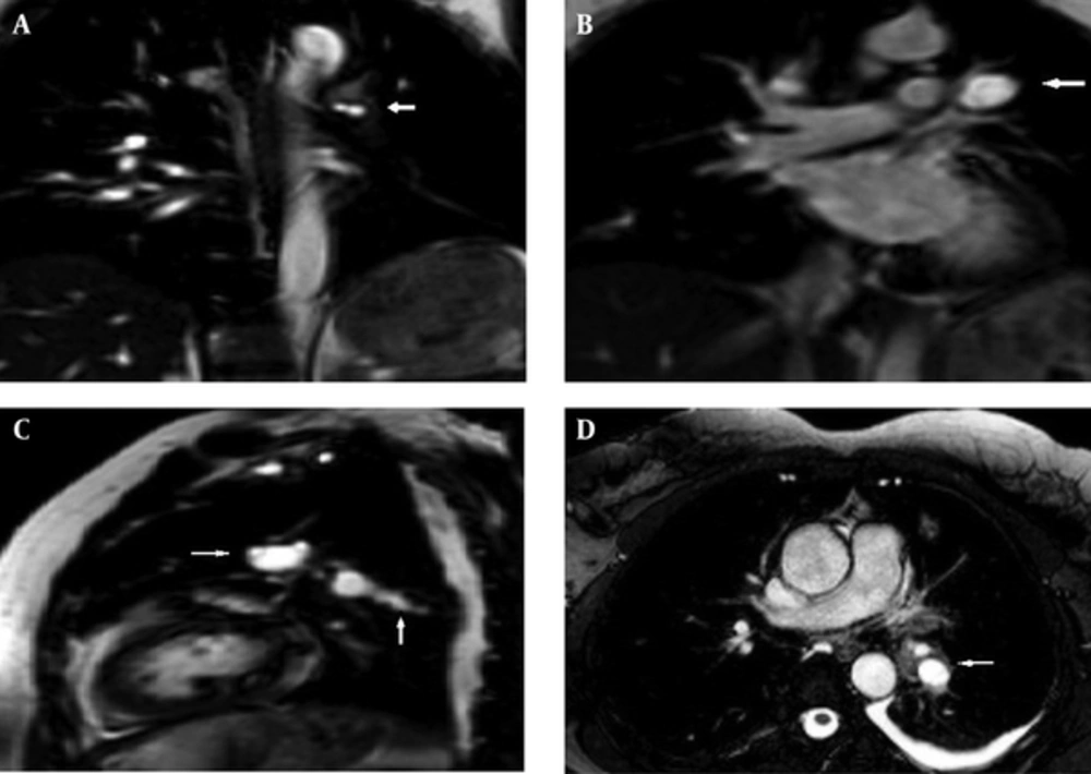 T1 Weighted mri with contrast in coronal; A, B, sagittal; C, and axial D, slices. The main and descending pulmonary arteries not being filled with contrast and hyperintense lesions suggest pulmonary artery hydatid cyst. T1 Weighted mri with contrast in coronal; A, B, sagittal; C, and axial D, slices. The main and descending pulmonary arteries not being filled with contrast and hyperintense lesions suggest pulmonary artery hydatid cyst.