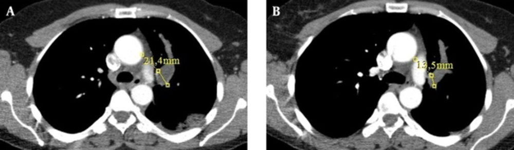 A, B, On control CT scan after one year of therapy, decrease of 7.9 mm in diameter of the cyst in the left pulmonary artery is seen A, B, On control CT scan after one year of therapy, decrease of 7.9 mm in diameter of the cyst in the left pulmonary artery is seen