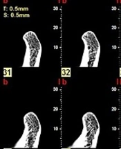 Evaluating Diagnostic Efficacy of Cone Beam Computed Tomography Performed in Different Imaging Conditions Based on Field of View and Resolution in the Detection of Mandibular Condyle Erosions: An In Vitro Study