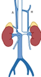 Unusual Pattern of Left Inferior Vena Cava: A Case Report