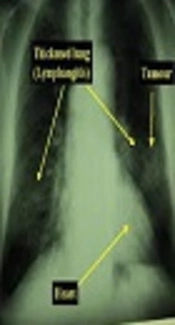 Thin-Walled Cavitary Lung Adenocarcinoma: A Rare Unusual Case