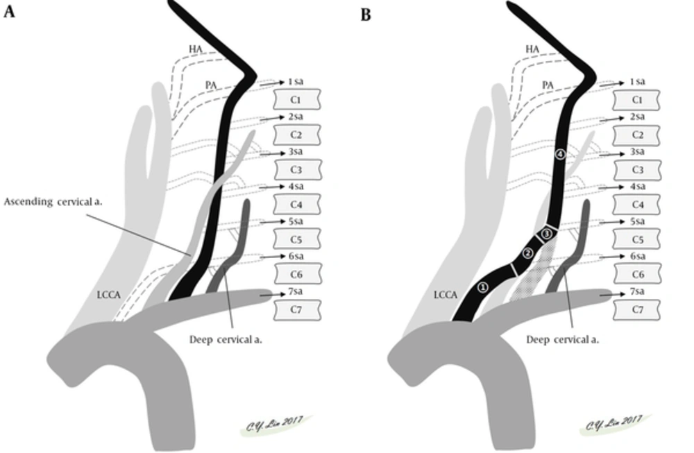 Schematic presentation of embryological development of normal VA (A) and common variation of left VA starting directly from the aortic arch (B). A, Normally, the VA formed by longitudinal intersegmental anastomosis between the C1 and C7 segmental arteries lies within the transverse foramen. Two other major cervical accessory paramedian intersegmental anastomoses (the ventral ascending cervical artery and the dorsal deep cervical artery) lie parallel to the VA. The difference in the entry level of the VA is related to dominance of a ventral or dorsal extraspinal group of longitudinal intersegmental anastomosis. B, The left VA is formed by persistent sixth cervical segmental artery (1) proximally, connecting to the corresponding ascending cervical artery (2), the 5th segmental artery (3) entering C5 transverse foramen, and following normal foraminal VA course (4) distally. In this variation, the left VA will enter the transverse foramen at C5 level, while the ascending cervical artery will not be depicted as a separate vessel. Abbreviations: HA, hypoglossal artery; LCCA, left common carotid artery; PA, proatlantal artery; sa, segmental artery; VA, vertebral artery. Schematic presentation of embryological development of normal VA (A) and common variation of left VA starting directly from the aortic arch (B). A, Normally, the VA formed by longitudinal intersegmental anastomosis between the C1 and C7 segmental arteries lies within the transverse foramen. Two other major cervical accessory paramedian intersegmental anastomoses (the ventral ascending cervical artery and the dorsal deep cervical artery) lie parallel to the VA. The difference in the entry level of the VA is related to dominance of a ventral or dorsal extraspinal group of longitudinal intersegmental anastomosis. B, The left VA is formed by persistent sixth cervical segmental artery (1) proximally, connecting to the corresponding ascending cervical artery (2), the 5th segmental artery (3) entering C5 transverse foramen, and following normal foraminal VA course (4) distally. In this variation, the left VA will enter the transverse foramen at C5 level, while the ascending cervical artery will not be depicted as a separate vessel. Abbreviations: HA, hypoglossal artery; LCCA, left common carotid artery; PA, proatlantal artery; sa, segmental artery; VA, vertebral artery.