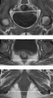 Cover image of the article: Effect of Sickle Cell Anemia on Pelvic Dimensions: A Magnetic Resonance Imaging Study