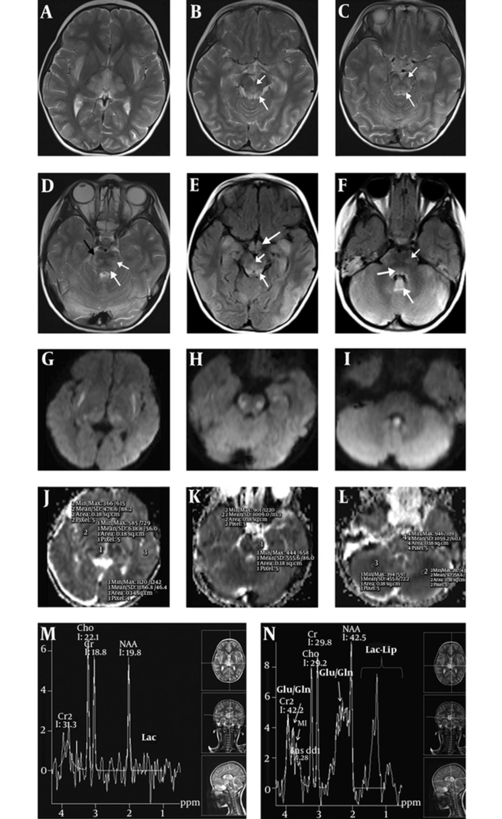 A 4 - year - old boy was admitted to our emergency clinic suffering from unconsciousness, vomiting and fever. On admission MRI, axial T2 (A, B, C, D) and FLAIR (E, F) images show bilateral symmetric hyperintense edematous changes in thalami and external capsules on A, Superior cerebellar peduncles (thin long arrows) and decussation of superior cerebellar peduncles (short arrows) on B and E, Hippocampi on B, C and E, Hypothalami (thick arrow on E), along tegmental tracts (long thin arrows on C, D and F), corticofugal fibers (black arrow on D) and lemniscal pathways (short arrows on C, D, F), and in the cerebellum on D, and F. The nodule (long thick arrow on F) of cerebellar vermis are seen more hyperintense compared to the rest of the cerebellum. There is associated diffusion restriction on diffusion weighted imaging (DWI) (G, H, and I) and corresponding apparent diffusion coefficient (ADC) maps (J, K, and L) in the external capsule, brain stem tracts and cerebellum. Mean ADC measurements from the external capsule (478 × 10 <sup>-6</sup> mm<sup>2</sup>/s), thalamus (638 × 10<sup>-6</sup> mm<sup>2</sup>/s), affected brain stem tract (555 × 10<sup>-6</sup> mm<sup>2</sup>/s) and cerebellum (358 × 10<sup>-6</sup> mm<sup>2</sup>/s) are shown on ADC maps (J, K, L). M - N, On long echo time (TE 135 ms), MR spectroscopy (M) shows elevated choline peak while short TE (TE 35 ms) (N) shows glutamine/glutamate peaks at 2.4 ppm and 3.8 ppm. Lipid - lactate peaks are seen on short echo (N) with doublet reversal on long echo (M). Cho: Choline, Glu/Gln: glutamate/glutamine, Lac: Lactate, Lac - Lip: Lactate - lipid, MI: myo - inositol. A 4 - year - old boy was admitted to our emergency clinic suffering from unconsciousness, vomiting and fever. On admission MRI, axial T2 (A, B, C, D) and FLAIR (E, F) images show bilateral symmetric hyperintense edematous changes in thalami and external capsules on A, Superior cerebellar peduncles (thin long arrows) and decussation of superior cerebellar peduncles (short arrows) on B and E, Hippocampi on B, C and E, Hypothalami (thick arrow on E), along tegmental tracts (long thin arrows on C, D and F), corticofugal fibers (black arrow on D) and lemniscal pathways (short arrows on C, D, F), and in the cerebellum on D, and F. The nodule (long thick arrow on F) of cerebellar vermis are seen more hyperintense compared to the rest of the cerebellum. There is associated diffusion restriction on diffusion weighted imaging (DWI) (G, H, and I) and corresponding apparent diffusion coefficient (ADC) maps (J, K, and L) in the external capsule, brain stem tracts and cerebellum. Mean ADC measurements from the external capsule (478 × 10 <sup>-6</sup> mm<sup>2</sup>/s), thalamus (638 × 10<sup>-6</sup> mm<sup>2</sup>/s), affected brain stem tract (555 × 10<sup>-6</sup> mm<sup>2</sup>/s) and cerebellum (358 × 10<sup>-6</sup> mm<sup>2</sup>/s) are shown on ADC maps (J, K, L). M - N, On long echo time (TE 135 ms), MR spectroscopy (M) shows elevated choline peak while short TE (TE 35 ms) (N) shows glutamine/glutamate peaks at 2.4 ppm and 3.8 ppm. Lipid - lactate peaks are seen on short echo (N) with doublet reversal on long echo (M). Cho: Choline, Glu/Gln: glutamate/glutamine, Lac: Lactate, Lac - Lip: Lactate - lipid, MI: myo - inositol.