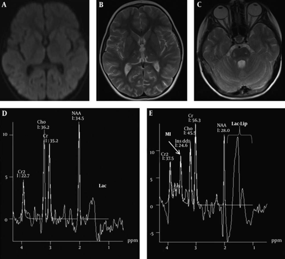 Control MRI performed 16 days later (A - E) shows that resolution of diffusion restriction on axial diffusion weighted imaging (DWI) (A) and decrease in the edematous hyperintense signal changes on axial T2W (B, C) images in the external capsules, thalami and brain stem. On long echo time (TE 135 ms) (D) and short TE (TE 35 ms) (E), MR spectroscopy views show elevations of choline, lactate and lipid peaks and resolution of glutamine/glutamate peaks. Lac: Lactate, Lac - Lip: Lactate - lipid, MI: myo - inositol. Control MRI performed 16 days later (A - E) shows that resolution of diffusion restriction on axial diffusion weighted imaging (DWI) (A) and decrease in the edematous hyperintense signal changes on axial T2W (B, C) images in the external capsules, thalami and brain stem. On long echo time (TE 135 ms) (D) and short TE (TE 35 ms) (E), MR spectroscopy views show elevations of choline, lactate and lipid peaks and resolution of glutamine/glutamate peaks. Lac: Lactate, Lac - Lip: Lactate - lipid, MI: myo - inositol.