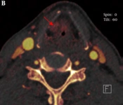 Quantitative Analysis of Cartilage Invasion by Laryngeal Carcinoma with Dual-Energy CT Iodine Overlay Images and Spectrum Curve