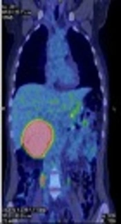 Cover image of the article: Contribution of 18F-FDG PET/CT in the Staging of Pancreatic Solid Pseudopapillary Neoplasms: A Case Report