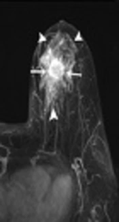 Cover image of the article: Invasive Carcinoma Arising in Microglandular Adenosis of the Breast: A Case Report and Literature Review