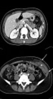 Cover image of the article: Radiologic Features of Distant Filler Migration with Inflammatory Reaction Following Augmentation Mammoplasty Using Aquafilling® Filler