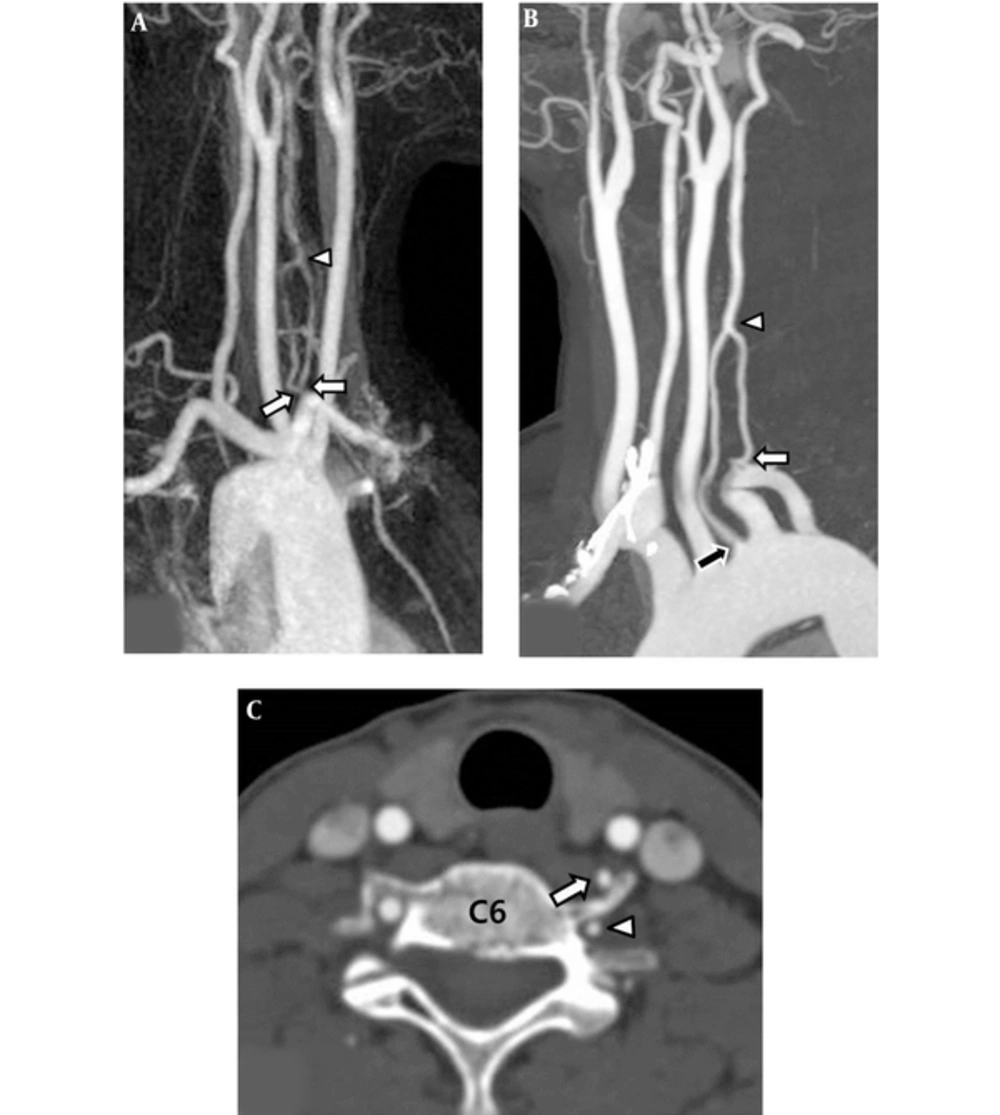 A 52-year-old woman with left duplicated vertebral artery. A, Three dimensional time-of-flight magnetic resonance angiography (3D TOF MRA) of right oblique view shows the double origin (arrows) of the left vertebral artery. Two limbs of the left' vertebral artery (VA) fused to form the distal part of the left VA (arrowhead). B, Contrast-enhanced computed tomography angiography (CTA) maximum intensity projection image demonstrated the dual origin of the left vertebral artery. The medial limb originated from the left aortic arch (black arrow) and lateral limb originated from the left subclavian artery (white arrow). The two limbs united to form one main trunk (arrow head). C, Axial source image of CTA demonstrated a medial limb (arrow) originated from the aortic arch and a lateral limb (arrowhead) originated from the left subclavian artery at the C6 vertebra level. A 52-year-old woman with left duplicated vertebral artery. A, Three dimensional time-of-flight magnetic resonance angiography (3D TOF MRA) of right oblique view shows the double origin (arrows) of the left vertebral artery. Two limbs of the left' vertebral artery (VA) fused to form the distal part of the left VA (arrowhead). B, Contrast-enhanced computed tomography angiography (CTA) maximum intensity projection image demonstrated the dual origin of the left vertebral artery. The medial limb originated from the left aortic arch (black arrow) and lateral limb originated from the left subclavian artery (white arrow). The two limbs united to form one main trunk (arrow head). C, Axial source image of CTA demonstrated a medial limb (arrow) originated from the aortic arch and a lateral limb (arrowhead) originated from the left subclavian artery at the C6 vertebra level.
