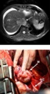 Leiomyosarcoma of the Inferior Vena Cava: A Case Report