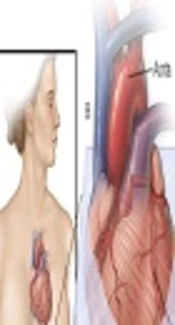 Coronary Artery Calcium Score Assessment in Breast Cancer Patients After Three-Dimensional Conformal Radiotherapy: Is Calcium Score an Appropriate Screening Study?
