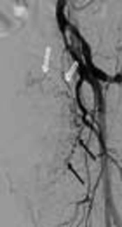 Cover image of the article: Superselective Embolization of Bilateral Inferior Vesical Arteries for the Management of Radiation-Induced Hemorrhagic Cystitis Refractory to Conventional Methods