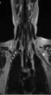 Cover image of the article: A Case Report of Symptomatic Subclavius Posticus Muscle in a Synchronized Swimmer