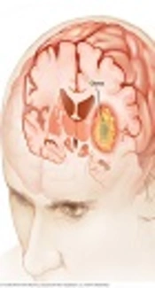 Cover image of the article: Multimodal MRI Techniques and Their Importance in Frameless Navigation Biopsy for Brain Glioma