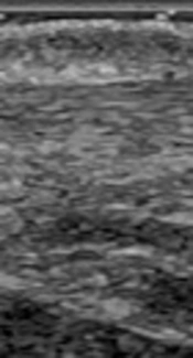 Achilles Tendon Thickness and Stiffness Evaluation with Shear-Wave Elastography in Hemodialysis Patients