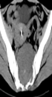 Quantitative Analysis of the Characteristics of Sacral Giant Cell Tumors Using Contrast-Enhanced Computed Tomography