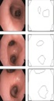 A Hybrid Method for Real-Time Bronchoscope Tracking Using Contour Registration and Synchronous EMT Data