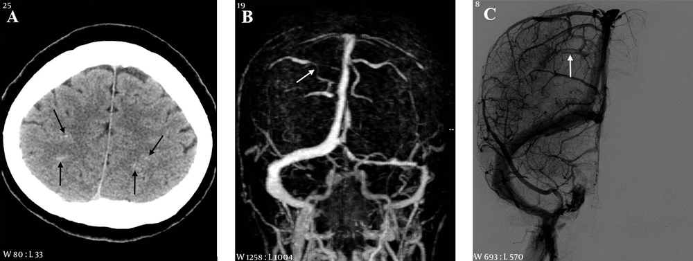 A 53-year-old female with headache and right weakness 3 days before imaging. A, CT scan shows subarachnoid hemorrhage in the cortical sulci of both cerebral convexities (arrows); B, MR venography reveals segmental narrowing in a right cortical vein (arrow); C, On digital subtraction angiography (DSA), there is a filling defect in a right cortical vein (arrow). A 53-year-old female with headache and right weakness 3 days before imaging. A, CT scan shows subarachnoid hemorrhage in the cortical sulci of both cerebral convexities (arrows); B, MR venography reveals segmental narrowing in a right cortical vein (arrow); C, On digital subtraction angiography (DSA), there is a filling defect in a right cortical vein (arrow).