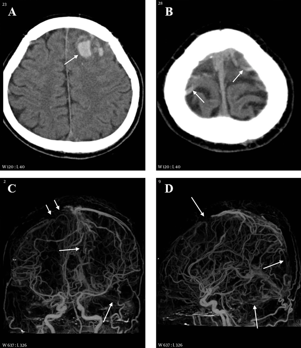 A 38-year-old male with headache, altered mentality and right weakness 2.5 hours before imaging. A, CT scan shows multiple hemorrhages in the left frontal lobe and adjacent cortical sulci (arrow); B, CT scan of the cerebral vertex level reveals hyperdense cortical veins (arrows) at both cerebral convexities; C and D, On CT venography frontal (C) and lateral (D) projection images, the cortical vein (short arrows) and superior sagittal and transverse sinuses (long arrows) are extensively thrombosed. A 38-year-old male with headache, altered mentality and right weakness 2.5 hours before imaging. A, CT scan shows multiple hemorrhages in the left frontal lobe and adjacent cortical sulci (arrow); B, CT scan of the cerebral vertex level reveals hyperdense cortical veins (arrows) at both cerebral convexities; C and D, On CT venography frontal (C) and lateral (D) projection images, the cortical vein (short arrows) and superior sagittal and transverse sinuses (long arrows) are extensively thrombosed.
