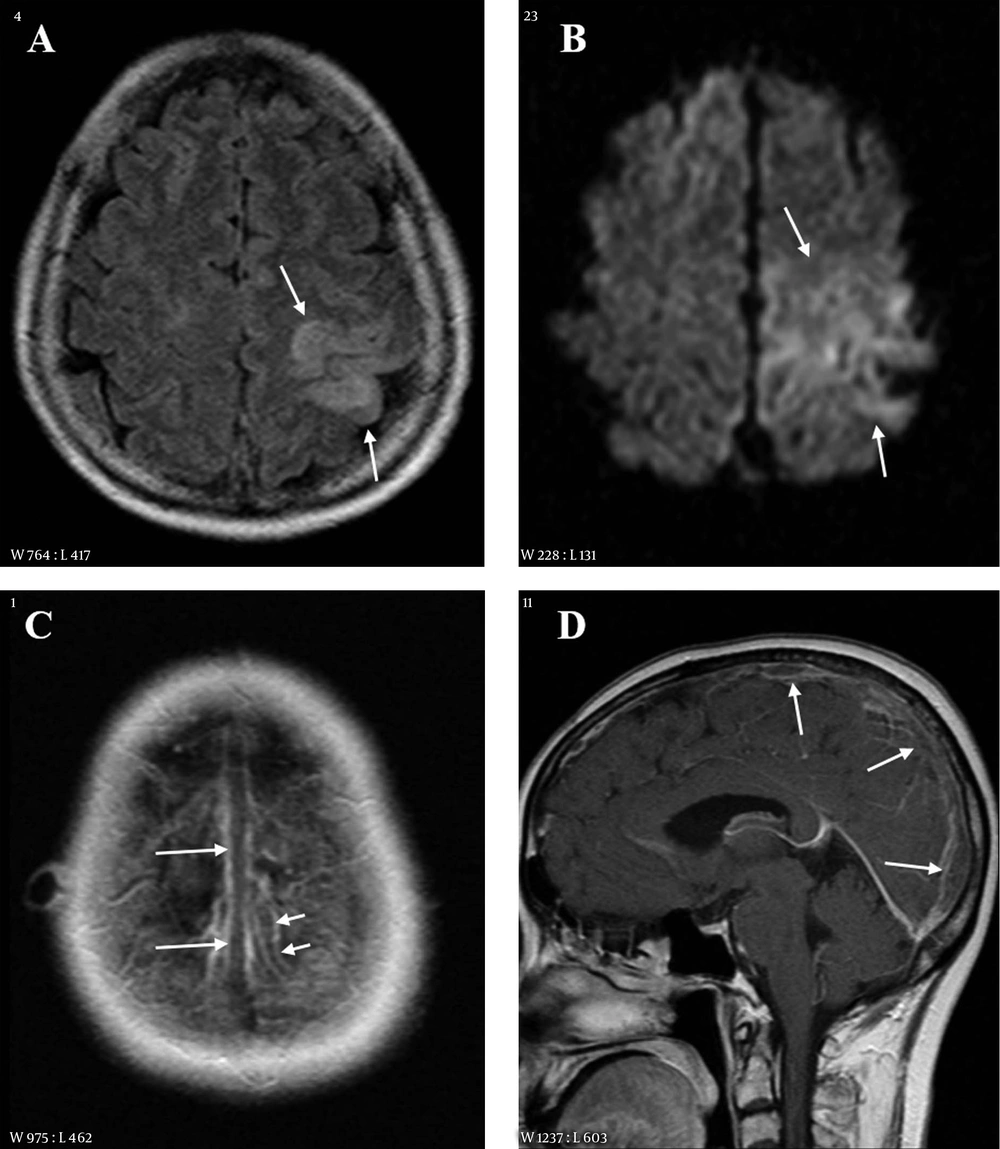 A 55-year-old female with right weakness and seizure 10 hours before imaging. A, Fluid attenuated inversion recovery (FLAIR) image shows a hyperintense lesion in the left parietal lobe; B, Diffusion weighted imaging (DWI) also reveals the lesion as hyperintensity. The extent of lesion is larger than that on FLAIR; C and D, Contrast enhanced axial (C) and sagittal (D) images show filling defects in the superior sagittal sinus (long arrows) and in a cortical vein of the left parietal area (short arrows). A 55-year-old female with right weakness and seizure 10 hours before imaging. A, Fluid attenuated inversion recovery (FLAIR) image shows a hyperintense lesion in the left parietal lobe; B, Diffusion weighted imaging (DWI) also reveals the lesion as hyperintensity. The extent of lesion is larger than that on FLAIR; C and D, Contrast enhanced axial (C) and sagittal (D) images show filling defects in the superior sagittal sinus (long arrows) and in a cortical vein of the left parietal area (short arrows).