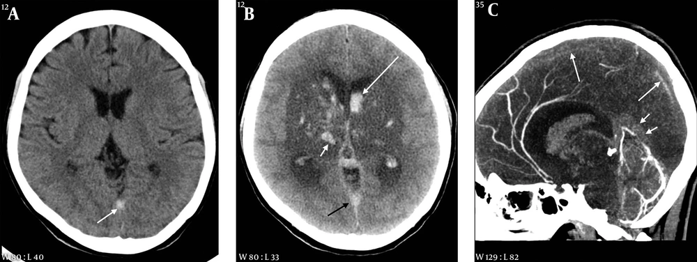 A 35-year-old female with headache and seizure 3 days and 1 hour before imaging, respectively. A, Initial CT scan obtained at an outside hospital shows a hyperdense lesion in the straight sinus area; B, On follow-up CT taken after seizure, there is a large hypodense lesion involving both basal ganglia and thalami. Multiple hemorrhages are associated within the lesion (white short arrow) and in both lateral ventricles (white long arrow). A hyperdense lesion is also seen in the straight sinus area (black arrow); C, Sagittal reformation CT venography image reveals extensive thrombosis in the superior sagittal (long arrows) and straight sinuses (short arrows). A 35-year-old female with headache and seizure 3 days and 1 hour before imaging, respectively. A, Initial CT scan obtained at an outside hospital shows a hyperdense lesion in the straight sinus area; B, On follow-up CT taken after seizure, there is a large hypodense lesion involving both basal ganglia and thalami. Multiple hemorrhages are associated within the lesion (white short arrow) and in both lateral ventricles (white long arrow). A hyperdense lesion is also seen in the straight sinus area (black arrow); C, Sagittal reformation CT venography image reveals extensive thrombosis in the superior sagittal (long arrows) and straight sinuses (short arrows).