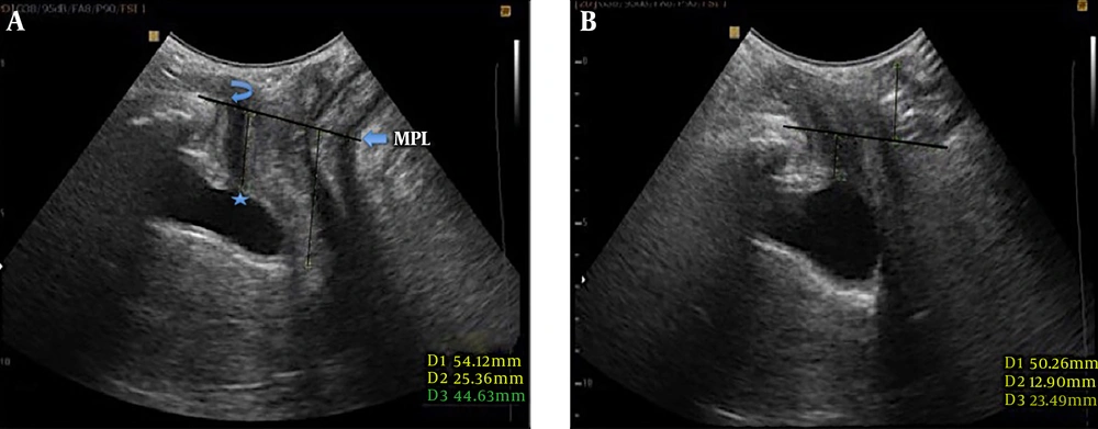A 36-year-old female with difficulty in defecation. A, Midsagittal plane of the pelvic floor at rest. Position of the bladder neck (Asterisk) and inferior margin of symphysis pubis (curved arrow) are shown. B, The same plane during Valsalva maneuver. The bladder neck is still above the reference midpelvic line (MPL), however the anorectal angle descent below the reference line is visualized along with protrusion of the anterior rectal wall. Findings are compatible with anterior rectocele. A 36-year-old female with difficulty in defecation. A, Midsagittal plane of the pelvic floor at rest. Position of the bladder neck (Asterisk) and inferior margin of symphysis pubis (curved arrow) are shown. B, The same plane during Valsalva maneuver. The bladder neck is still above the reference midpelvic line (MPL), however the anorectal angle descent below the reference line is visualized along with protrusion of the anterior rectal wall. Findings are compatible with anterior rectocele.