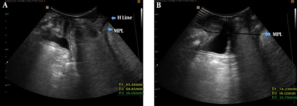 A, The midsagittal image of the pelvic floor at rest shows the position of the bladder neck above the midpelvic line (MPL). Anterior protrusion of the anterior rectal wall is also seen. B, The same plane in maximum Valsalva maneuver shows bladder neck descent below MPL (16 mm) consistent with cystocele. The anterior rectal wall is seen in a lower position compared to the image at rest. A, The midsagittal image of the pelvic floor at rest shows the position of the bladder neck above the midpelvic line (MPL). Anterior protrusion of the anterior rectal wall is also seen. B, The same plane in maximum Valsalva maneuver shows bladder neck descent below MPL (16 mm) consistent with cystocele. The anterior rectal wall is seen in a lower position compared to the image at rest.