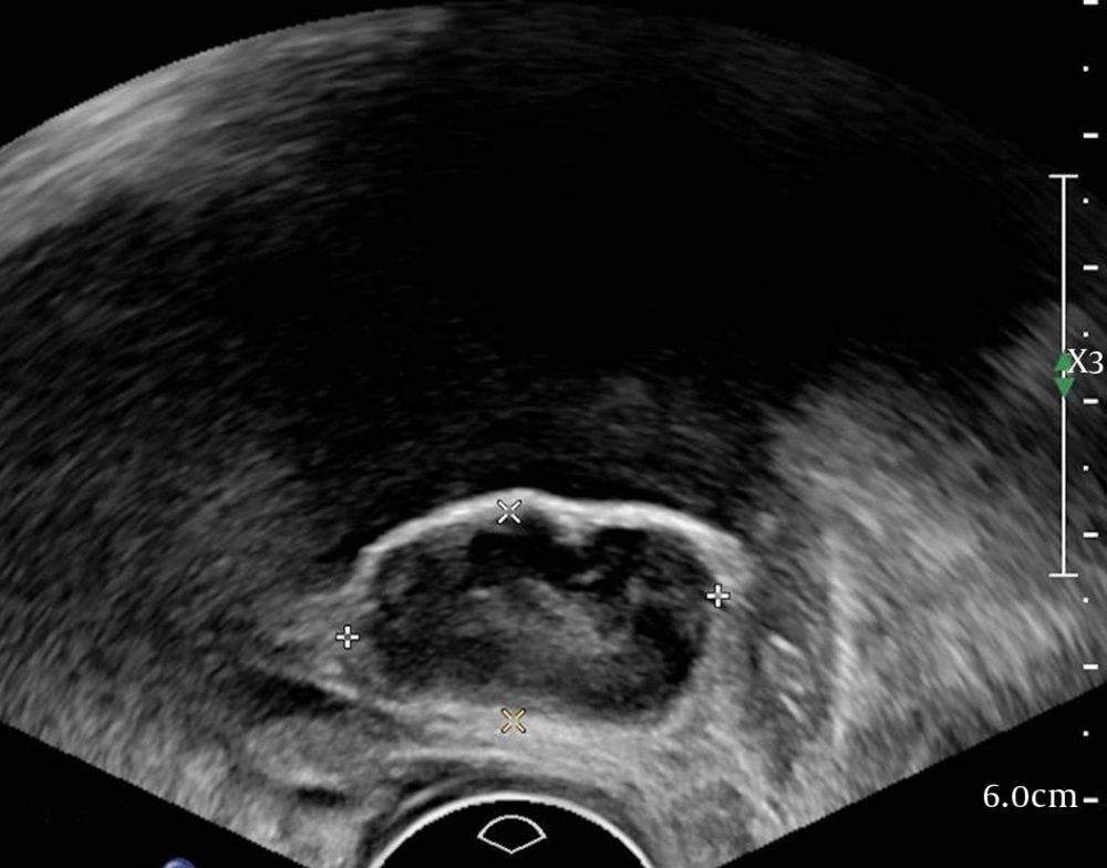 A 58-year-old woman with bladder neoplasm. Sagittal transvaginal sonogram shows a well-defined, hypoechoic mass in the posterior wall. A 58-year-old woman with bladder neoplasm. Sagittal transvaginal sonogram shows a well-defined, hypoechoic mass in the posterior wall.