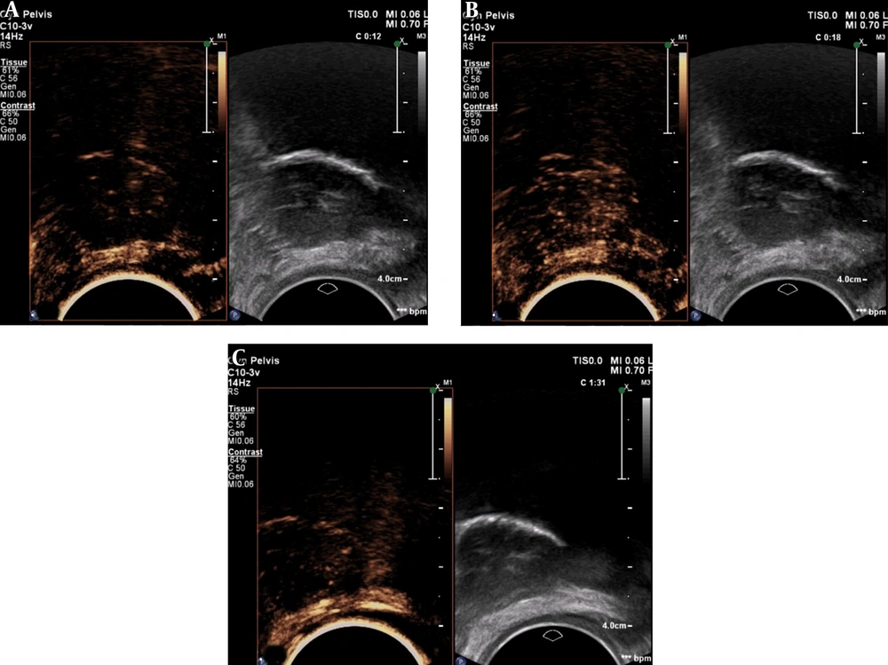 Contrast-enhanced ultrasound in the same patient. A, Contrast agent wash-in at 12 seconds; B, Maximum enhancement signal at 18 seconds; C, A small amount of microbubbles is still present at 91 seconds. Contrast-enhanced ultrasound in the same patient. A, Contrast agent wash-in at 12 seconds; B, Maximum enhancement signal at 18 seconds; C, A small amount of microbubbles is still present at 91 seconds.