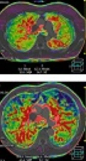 Pulmonary Dual Hemodynamic Changes in Severe COPD Patients: A Quantitative Study Using Low-Dose CT Lung Perfusion Scan