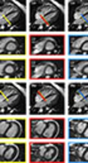 Impact of Basal Plane Selection on the Evaluation of Cardiac Performance Parameters with Cardiac Magnetic Resonance Imaging in Patients with Corrected Tetralogy of Fallot: A Systematic Approach