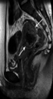 Effectiveness of Selective Transcatheter Arterial Embolization in Delayed Postpartum Hemorrhage