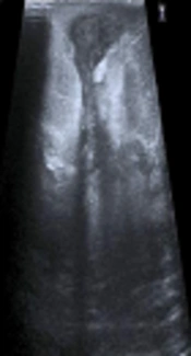 Clinical and Radiological Differences Between Fistular and Non-Fistular Idiopathic Granulomatous Mastitis