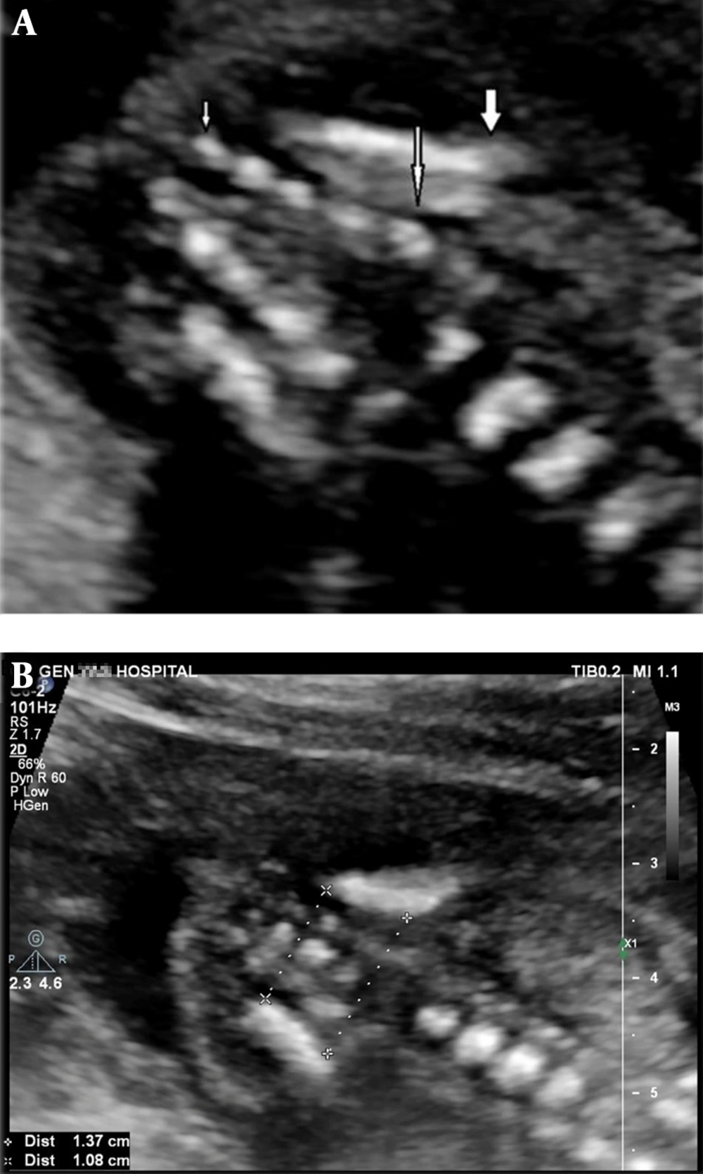 A, Ultrasound scan at 19 weeks of gestation in the coronal section in spine up position shows 5 sacral ossification nuclei. Thick arrow: upper contour of iliac wing; large thin arrow: S1; small thin arrow: S5; B, Method of bi-iliac distance measurement in the same section in another 19 weeks gestation fetus A, Ultrasound scan at 19 weeks of gestation in the coronal section in spine up position shows 5 sacral ossification nuclei. Thick arrow: upper contour of iliac wing; large thin arrow: S1; small thin arrow: S5; B, Method of bi-iliac distance measurement in the same section in another 19 weeks gestation fetus