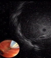 Diagnostic Value of Endobronchial Ultrasonography with A Guide Sheath Combined with Virtual Bronchoscopic Biopsy for Pulmonary Peripheral Lesions