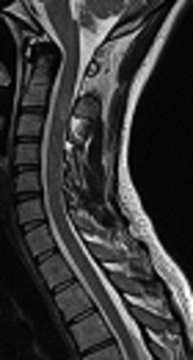 Comparison Between T2, STIR and PSIR Sequences, for Detection of Cervical Cord MS Plaques