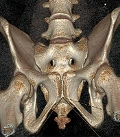 Use of Foramen Obturatum and Subpubic Angle in Sex Determination: Diagnostic Accuracy of Anthropometric Measurement on MDCT Images