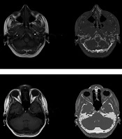 Pseudo-CT Generation for External Radiotherapy Planning from Magnetic Resonance Imaging Data on Brain Regions