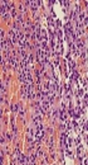 Aggressive Typical Carcinoid Tumor of the Sphenoid Sinus with Uncommon Clinicopathological Presentation