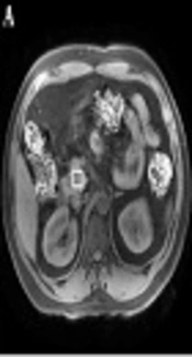 Quantification of Pancreatic Fat Accumulation by Proton Magnetic Resonance Spectroscopy in Patients with Newly Diagnosed Type 2 Diabetes Mellitus